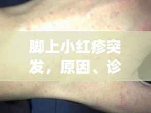 脚上小红疹突发,原因、诊断及有效治疗方法全解析